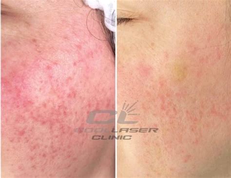 Symptoms and ways to treat rosacea in Kiev - Coolaser Clinic