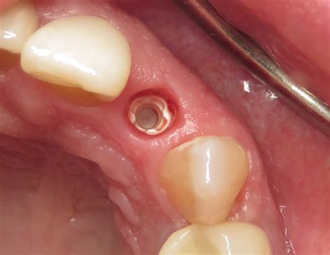 Ceramic Dental Implants Where Aesthetics Matter - Dentistry Today