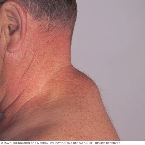 Cancer Tumor On Back Of Neck - CancerWalls