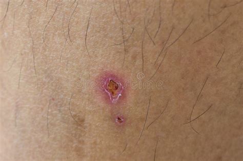 Feridinhas No Corpo O Que Pode Ser - Infecção Por Feridas Na Pele Uma Ferida No Corpo Humano, Sutura Antiga ...