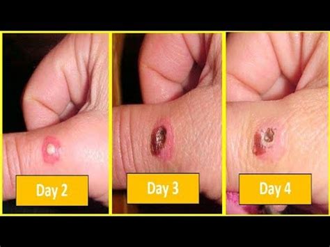 Recluse Spider Bite Stages