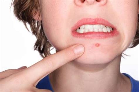 Soluciones contra los barros | Toque de Mujer