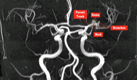 Brain Aneurysm Surgery – Middle Cerebral Artery Aneurysm | C.N.S. Neurosurgery