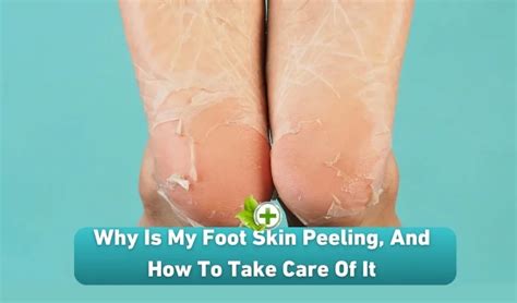 Why Is My Foot Skin Peeling, And How To Take Care Of It