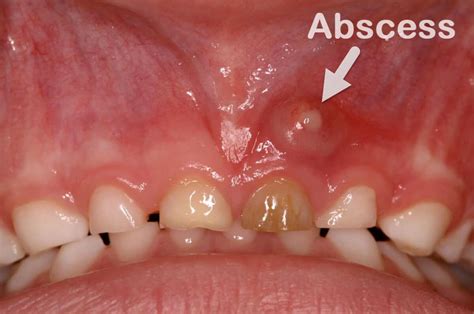 Is Dental Abscess an Emergency? - Dentist Brisbane