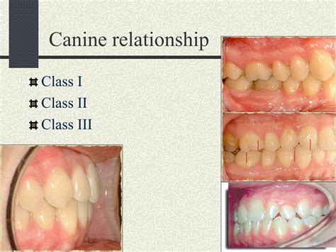 dental occlusion classification canine
