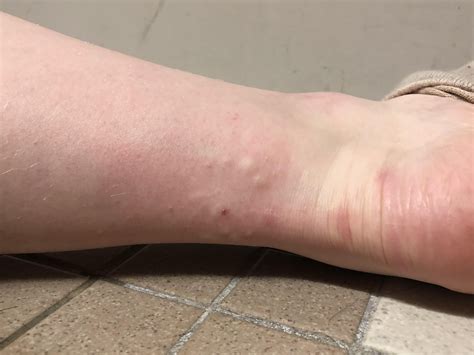 What kind of bug bites are these? (All on same ankle) : r/DiagnoseMe