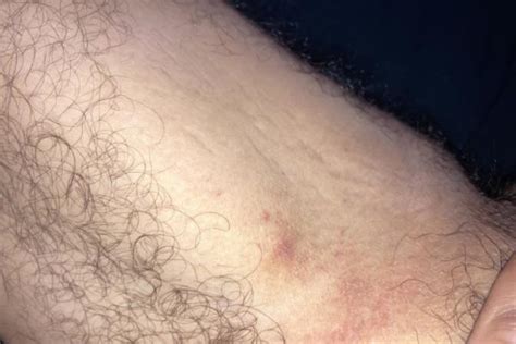 Rash on inner thigh | FindATopDoc