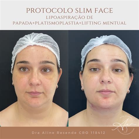Platismoplastia O Que É - Platismoplastia - o que é? - Clínica Aline Resende