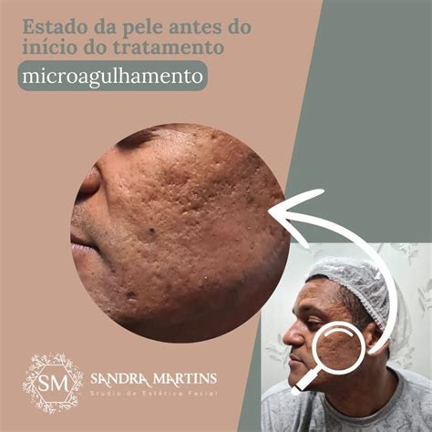 O Que É Microagulhamento Facial - O guia completo dos cuidados pós microagulhamento em Brasília para uma ...