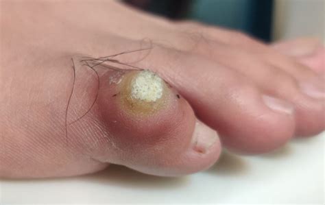 Corn vs Wart on Foot: How to Tell the Difference and Get Treatment