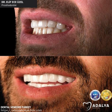Dental Veneers Turkey: Cost 2024, Porcelain, Antalya, Packages