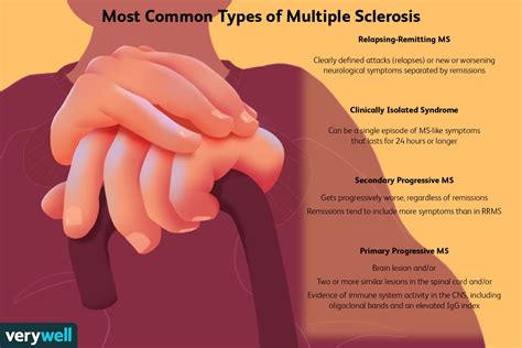 Types of Multiple Sclerosis (MS): Progression, Outlook
