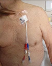 dialysis fistula port