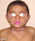 pellagra - Pictures