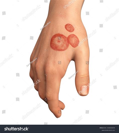 Tinea Manuum: Over 48 Royalty-Free Licensable Stock Illustrations