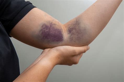 discoloration bruises image royalty  images stock