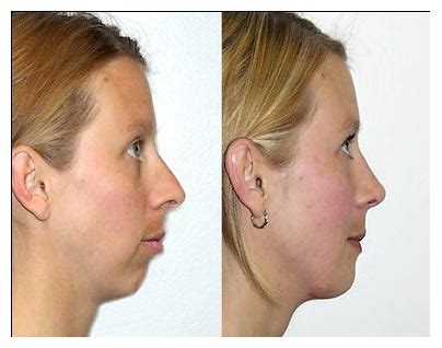 Plastic Surgery Before And After: Chin Augmentation Before And After