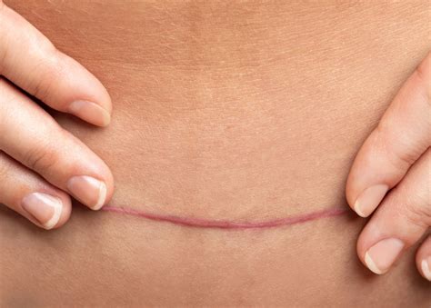 understanding  scar healing process