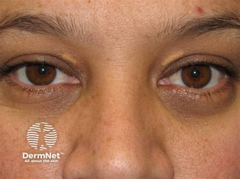 Xanthelasma images