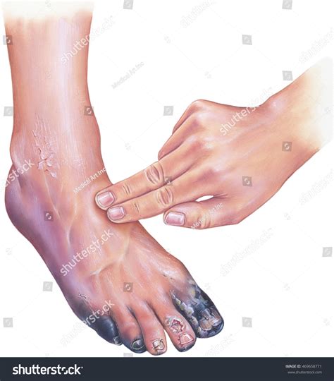 99 Gangrene foot Stock Illustrations, Images & Vectors | Shutterstock