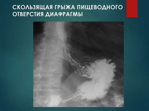 Грыжи живота. Осложненные грыжи. Диагностика и хирургическая тактика ...