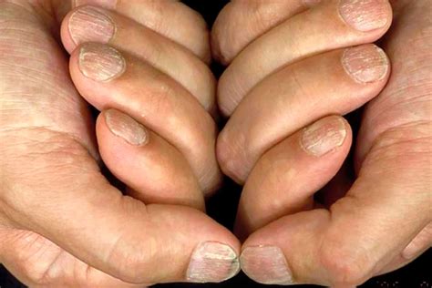 Alopecia Areata & Hair Loss: Causes, Treatments, and Tips to Cope