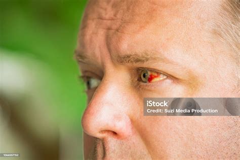 Subconjunctival Bleeding Stock Photo - Download Image Now - Blood ...