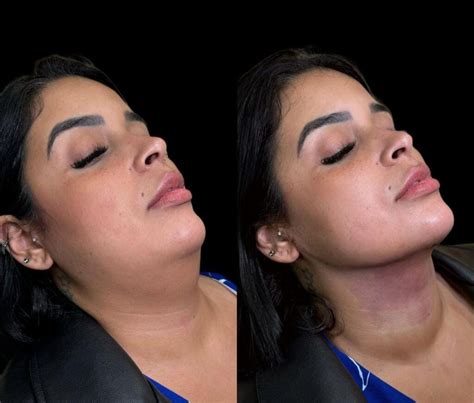 Quanto Tempo A Pele Cola Depois Da Lipo De Papada - Lipoaspiração de Papada: O que é, Valor, Procedimento