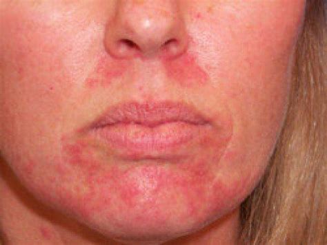 facial rash   treatment  health advisor