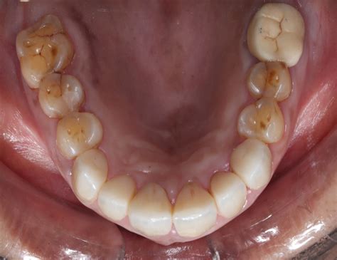 root canal treatment