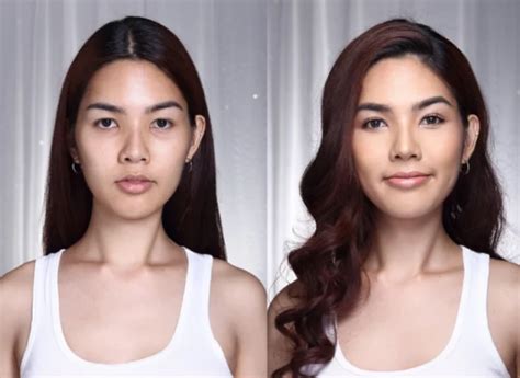 facial feminization surgery  turkey  complete guide  transgender