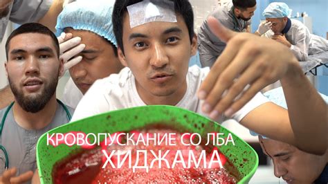Хиджама, Кровопускание со лба #Казахстан #Актау #Мангистау - YouTube