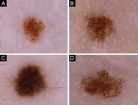 Benign Melanocytic Nevi