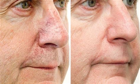 how to get rid of burst capillaries on face
