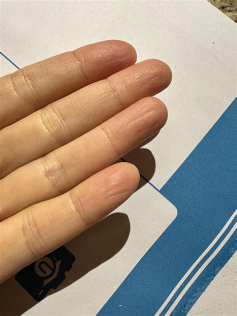 I’ve never been diagnosed with Raynards, because I have never had