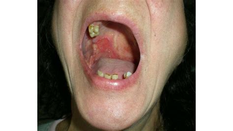 Oral Squamous Cell Carcinoma: Mouth Cancer Symptoms and More