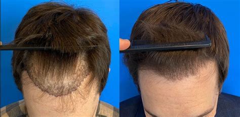 frontal hairline restoration  hair grafts hair restoration