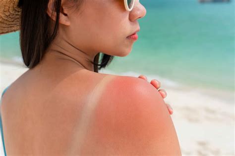 The Most Common Summer Skin Problems - Skin Technique