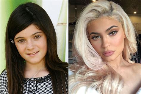 Kylie Jenner’s Plastic Surgeries - Milano Klinik