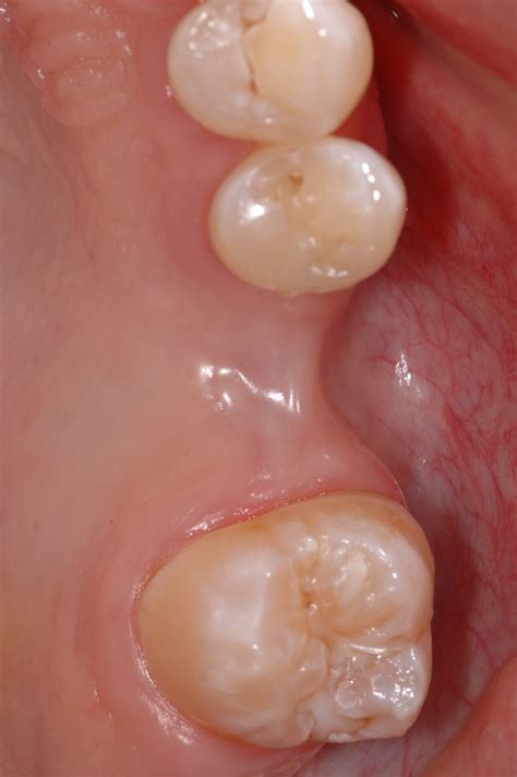 Baby Bottom Molars Coming In at Milla Gadsdon blog