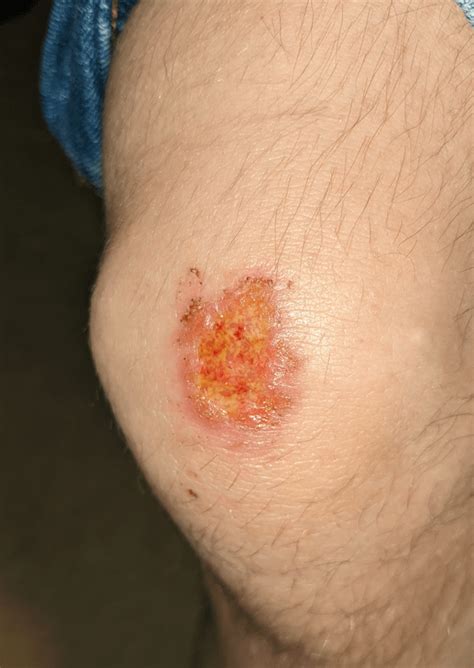 Next steps for healing an infected scrape? : r/woundcare