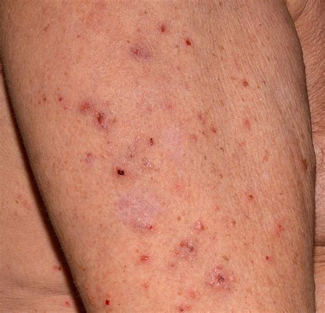 Early Scabies Rash Face Scabies: Images, symptoms, and treatments