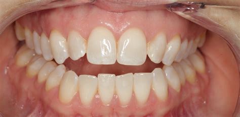 open bite  adults open bite symptoms   treatment umrqgo