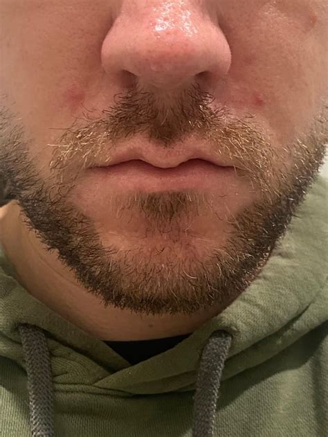 [acne] Inflamed pustules around the nose : r/SkincareAddiction