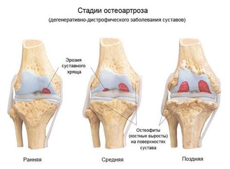 Остеофіти колінного суглоба