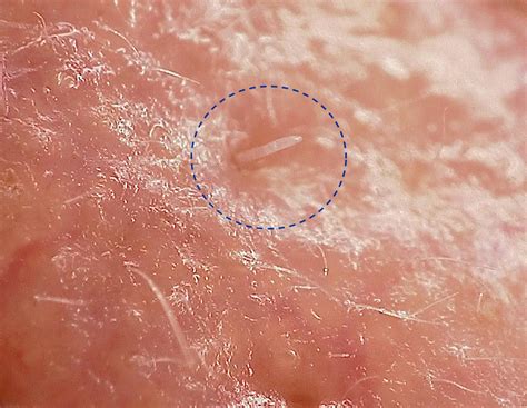 Unraveling the Mystery: Why Rodent Mites Choose Human Hosts