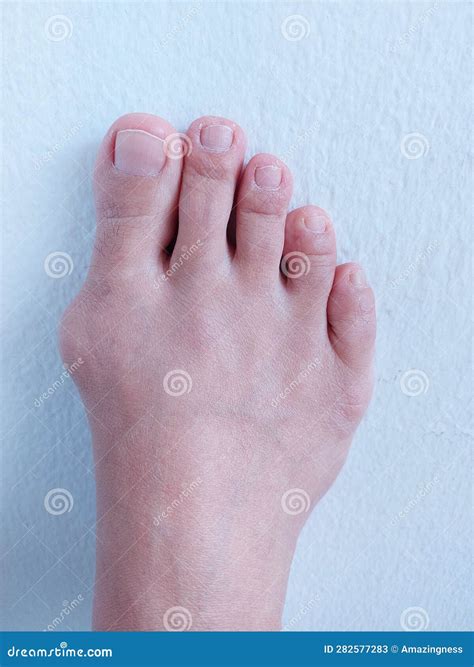 A Woman Right Foot with Hallux Valgus, Foot Bunions, Bony Bump. Stock