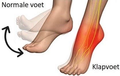 Wat is een klapvoet of dropvoet? - DeBraceShop.nl - Lees hier