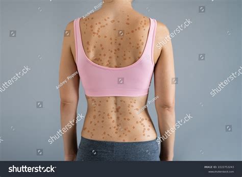 Woman Body Skin Rash Red Allergy Stock Photo 2222753243 | Shutterstock